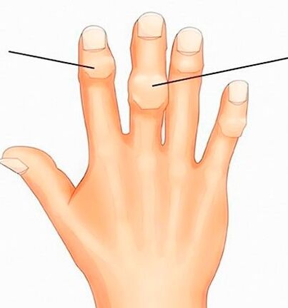 Noduli di Heberden e Bouchard sulle articolazioni interfalangee con artrosi