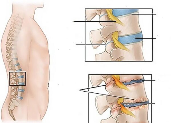 cambiamenti nei dischi dovuti all'osteocondrosi