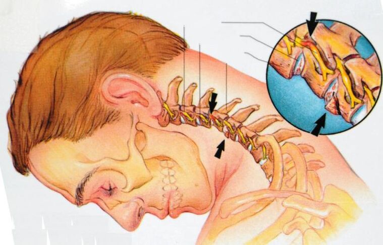sintomi dell'osteocondrosi cervicale
