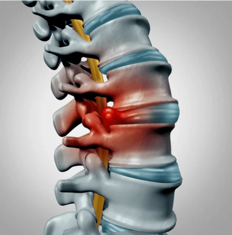 Protenza dei dischi intervertebrali